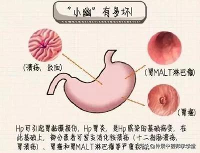 小巷深处的健康秘密，幽门螺旋杆菌最新治疗方法探索